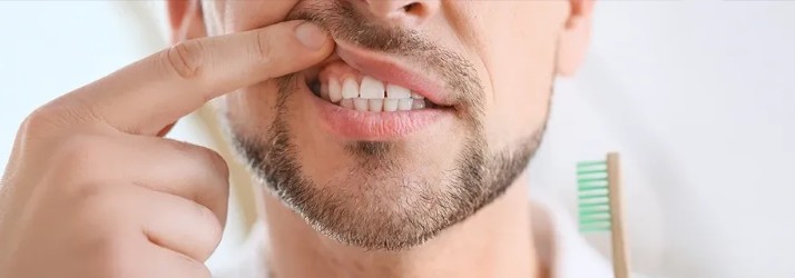 Gingivitis in South Gate CA